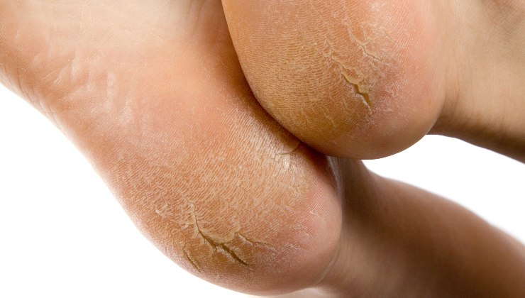 cracked heels: this is how to fix them