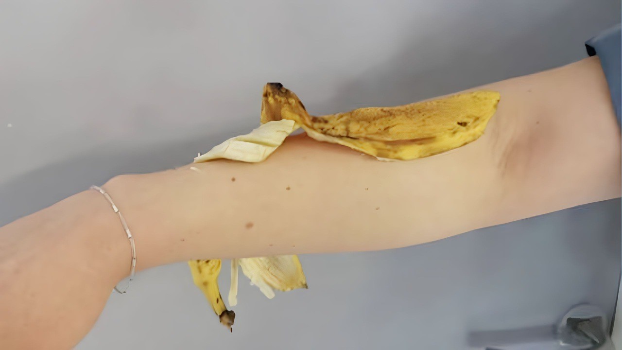 Buccia di banana sul braccio